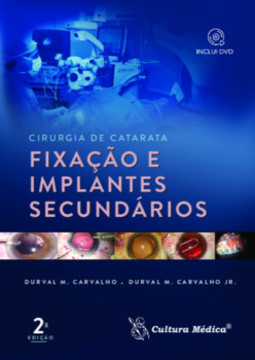 Cirurgia de catarata: fixação e implantes secundários