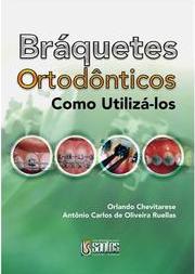 Braquetes Ortodônticos