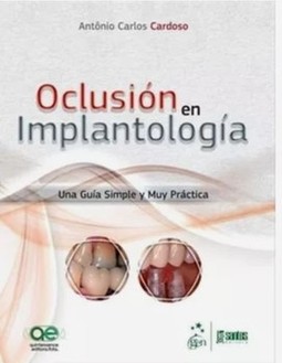 Oclusión en implantología: una guía simple y muy práctica