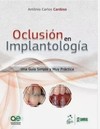 Oclusión en implantología: una guía simple y muy práctica