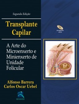 Transplante capilar: a arte do microenxerto e minienxerto de unidade folicular