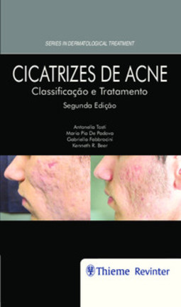 Cicatrizes de acne: classificação e tratamento