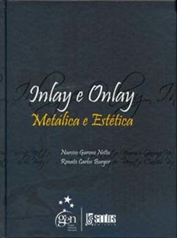 Inlay e Onlay - Metálica e estética