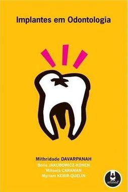 Implantes em Odontologia