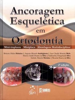 Ancoragem esquelética em ortodontia: Mini-implante, miniplaca, abordagem multidisciplinar