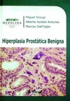 Hiperplasia prostática benigna