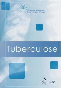 Tuberculose