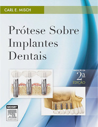 Prótese sobre implantes dentais