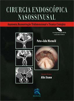 Cirurgia endoscópica nasossinusal
