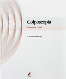 Colposcopia