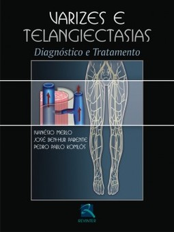 Varizes e telangiectasias: diagnóstico e tratamento