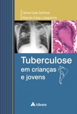 Tuberculose em criancas e jovens