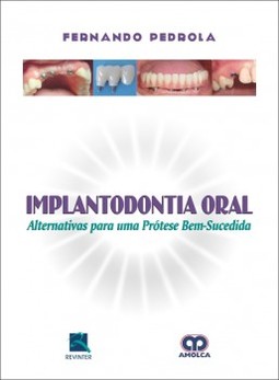 Implantodontia oral: alternativas para uma prótese bem-sucedida