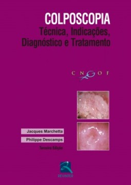 Colposcopia: técnica, indicações, diagnóstico e tratamento