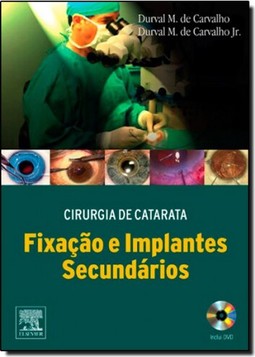 Cirurgia De Catarata Fixacao E Implantes Secundarios 1/E