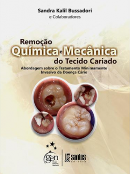 Remoção química e mecânica do tecido cariado: Abordagem sobre o tratamento minimamente invasivo da doença cárie