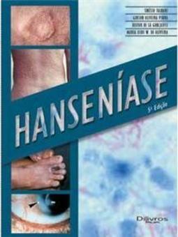 Hanseníase