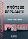 Prótese sobre implante: Só dentes anteriores