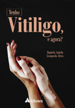 Tenho vitiligo, e agora?