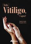 Tenho vitiligo, e agora?